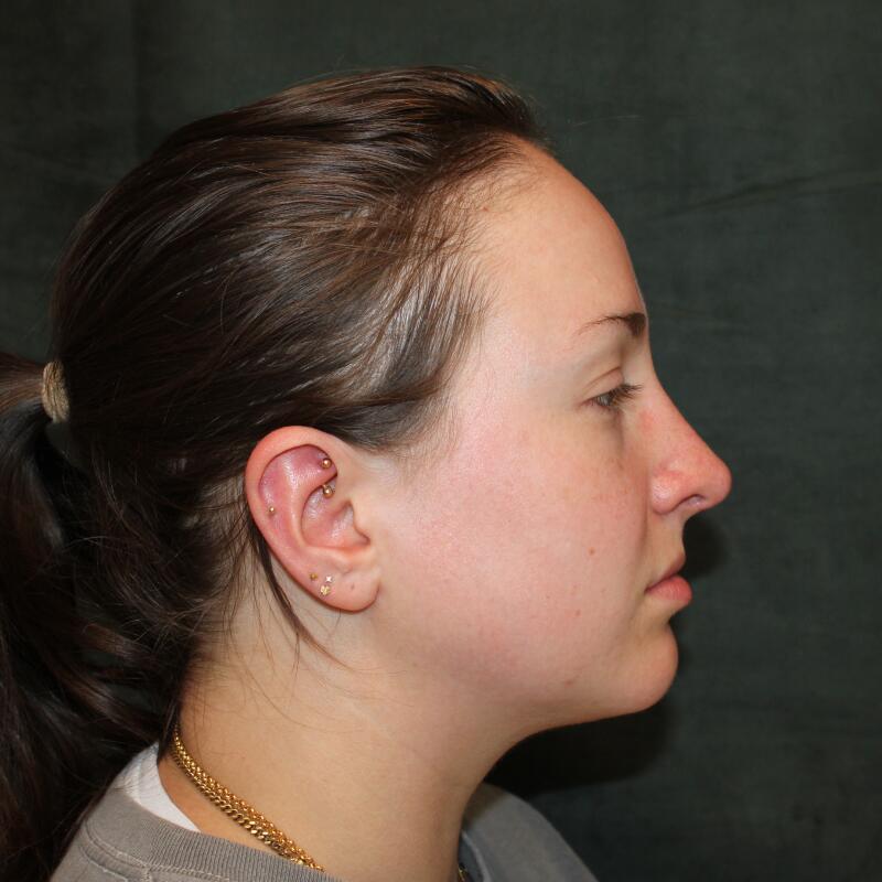 Rhinoplasty Before & After Image