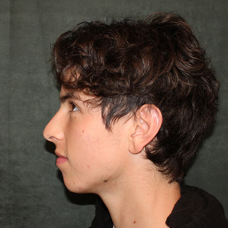 Rhinoplasty Before & After Image