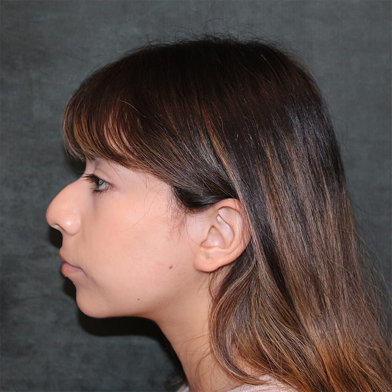 Rhinoplasty Before & After Image