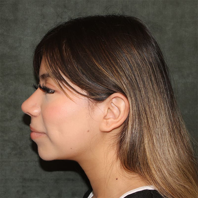 Rhinoplasty Before & After Image