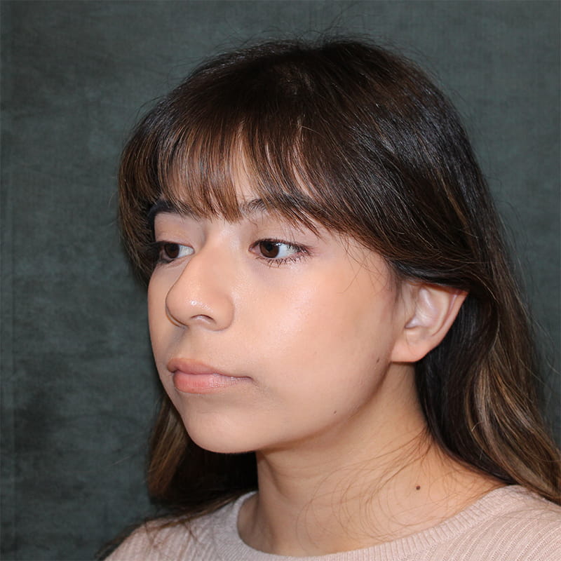 Rhinoplasty Before & After Image