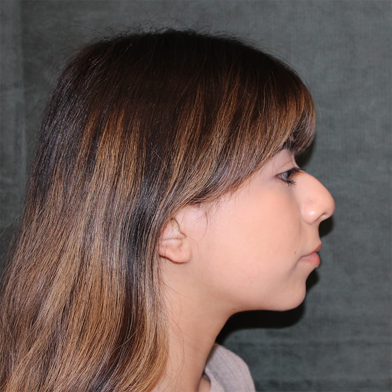 Rhinoplasty Before & After Image