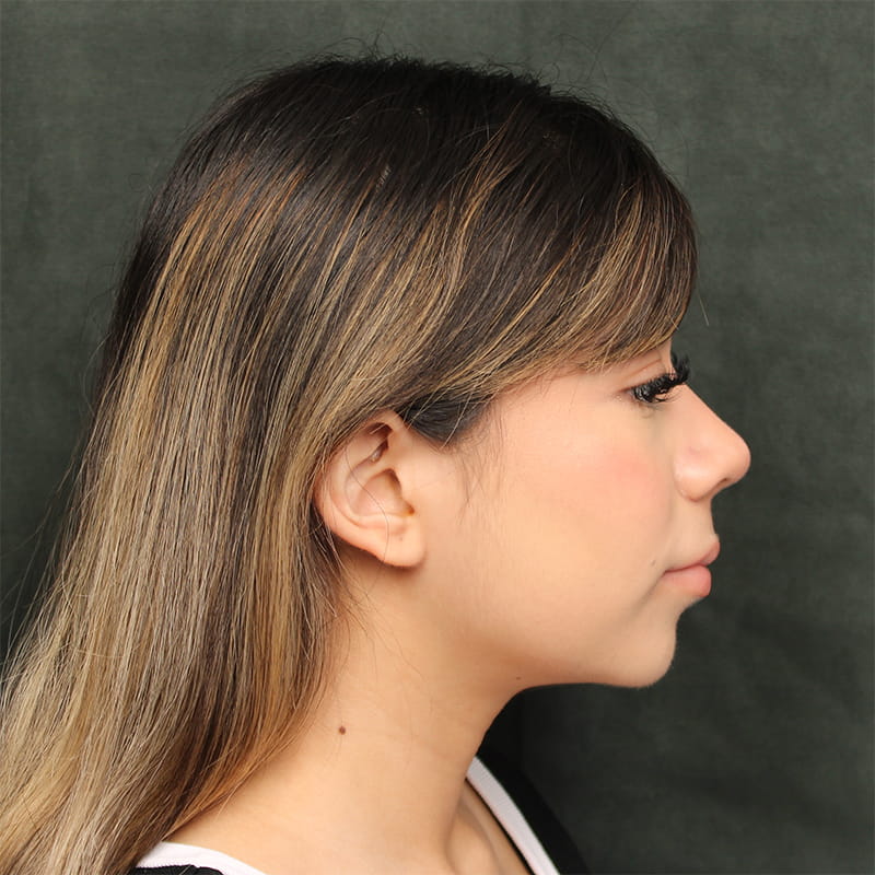 Rhinoplasty Before & After Image