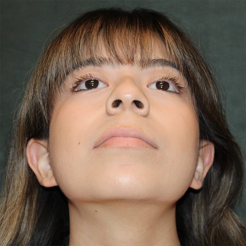 Rhinoplasty Before & After Image